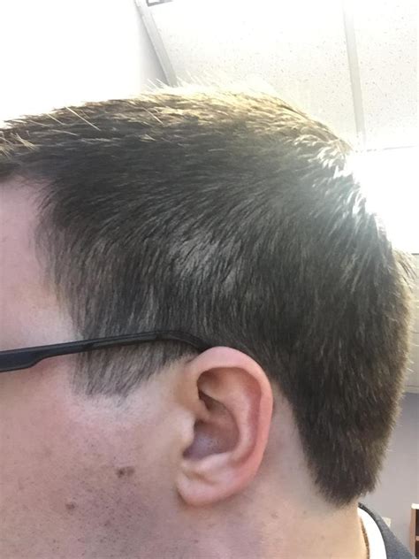 Really Thin Patches On Sides Of Head Directly Above Ears