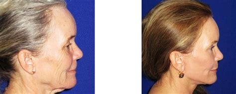Face Lift And Laser Resurfacing Before And After