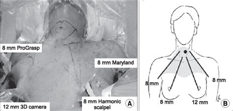 Figure 1 From Rupture Of Endotracheal Tube Cuff During Robot Assisted
