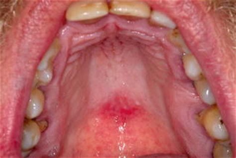 Median Rhomboid Glossitis Pocket Dentistry