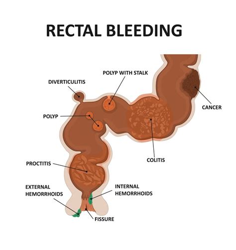 Rectal Bleeding And Bleeding From The Rectum Causes And Diagnosis The Best Porn Website