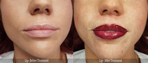 Permanent Lip Makeup Before After Pictures More Info Contact Us