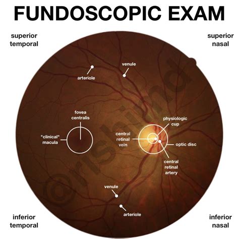Fundoscopic Examination Rkmd