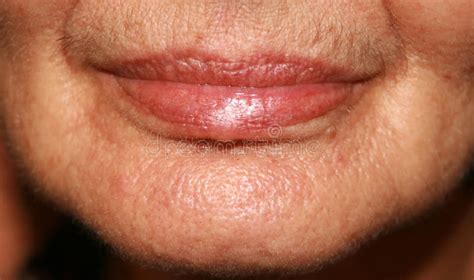 Lips Silicone Nasolabial Folds Wrinkles Around The