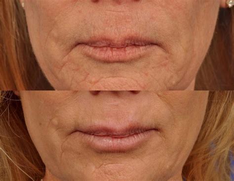 Microneedling Before And After Pictures W Skin Studio