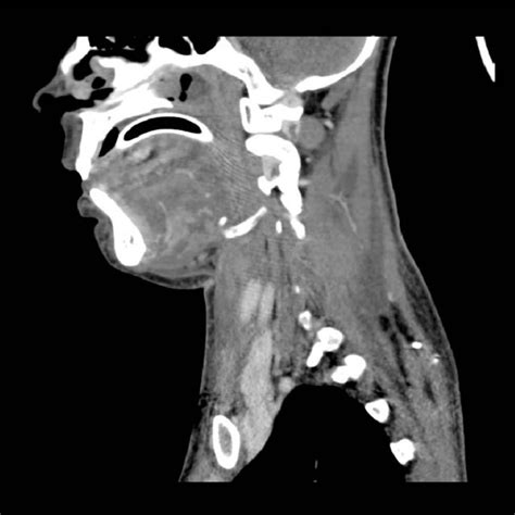 A Ct Scan Of Head And Neck Showing Soft Tissue Swelling And Airway