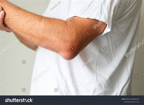 Man Swelling Erythematous Lump Pain Elbow Stock Photo 2216851011