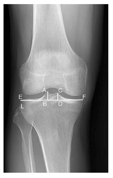 Ijerph Free Full Text Tibial Spine Height Measured By Radiograph Is