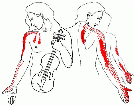 Arm Pins And Needles Thoracic Outlet Syndrome Roots