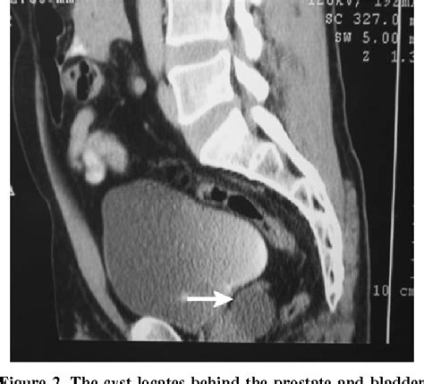 Figure 1 From Midline Prostatic Cysts Presenting With Chronic Prostatitis Or Secondary