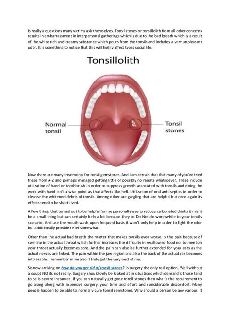 How To Get Rid Of Tonsil Stones Forever