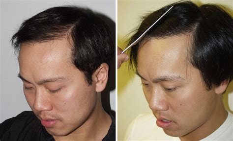 Hair Transplants For Men Reparative Hair Transplant Photos Miami Fl