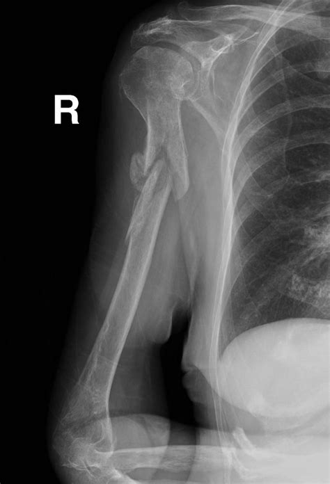 Humeral Shaft Fractures Trauma Orthobullets