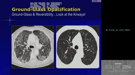 Here's how coronavirus can damage a person's lungs. Ground Glass Infiltrates On Ct Scan - ct scan machine
