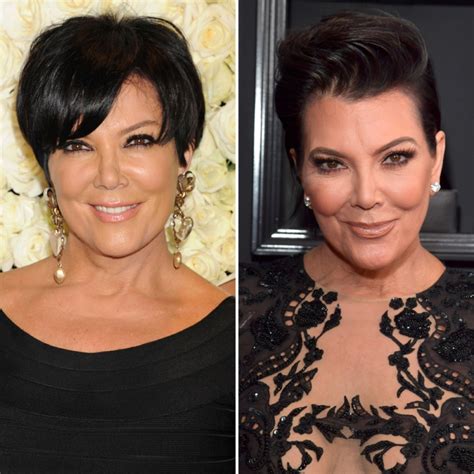 Celebrity Facelifts And Plastic Surgery See Then And Now Pics