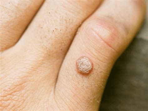 Viral Warts Cozmoderm Clinic Best Dermatology Clinic For Skin And