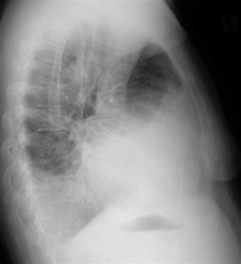 Pleural Effusion Cxr Lateral 2 Of 2 A Large Unilateral Flickr