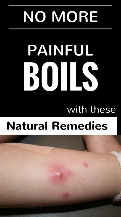 No More Painful Boils With These Natural Remedies Get Rid Of Boils