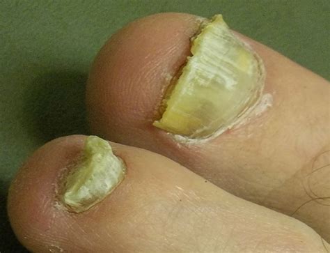 Think Toenails Treatment Causes Home Remedies Pictures