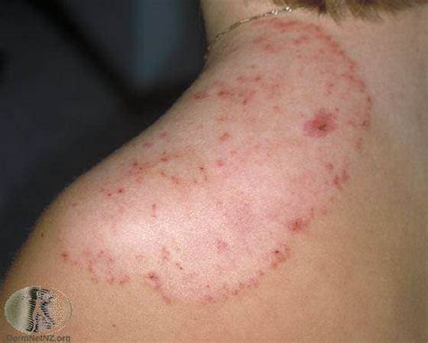 Tinea Treatment Ringworm Colorado Springs And Monument Co