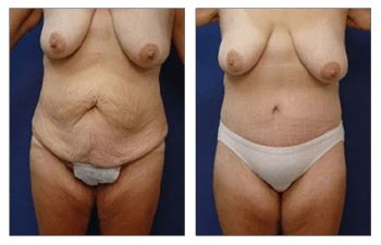 Post Bariatric Body Lift Beverly Hills Our Surgical Team