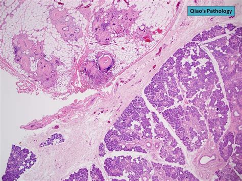 Qiaos Pathology Sialolithiasis And Chronic Sialadenitis Flickr
