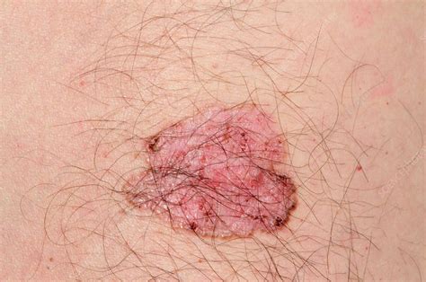 Basal Cell Skin Cancer On The Body Stock Image C0142435 Science