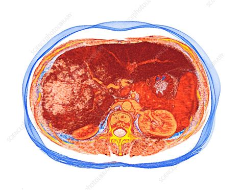 Liver Cancer Ct Scan Stock Image C0374664 Science Photo Library