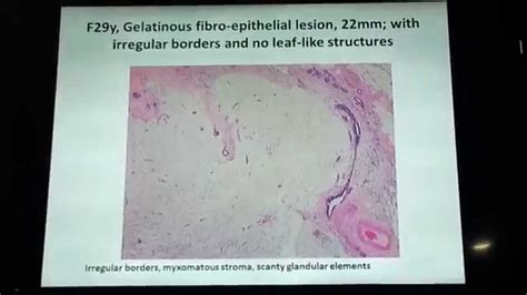 Differntiating Fibroadenoma From Phyllodes Tumor Youtube