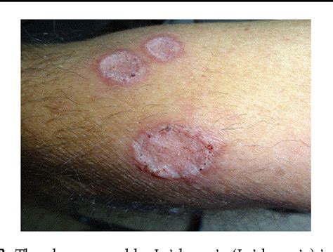 Figure From First Case Report Of Cutaneous Leishmaniasis Caused By Leishmania Leishmania