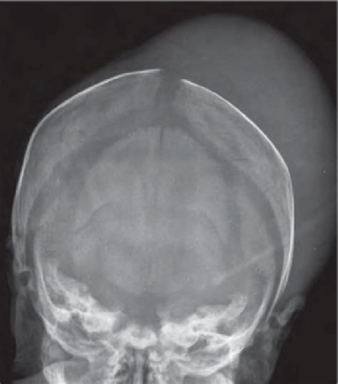 X Ray Of The Skull Showing Significant Soft Swelling Without Underlying