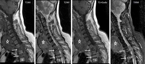 Metastatic Compression Fracture Radiology Cases