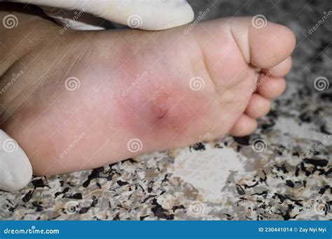 Cellulitis In The Foot Resulting From Nail Injury Stock Photo Image
