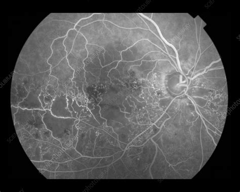 Hemi-Central Retinal Vein Occlusion - Stock Image - C027 ...