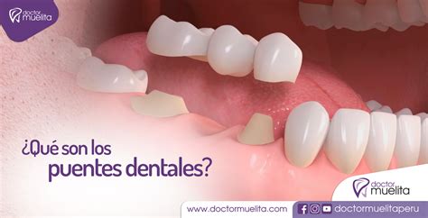 ¿qué Son Los Puentes Dentales Clínica Doctor Muelita