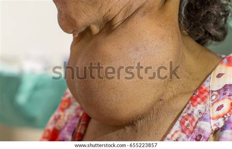 Lateral Zooming Closeup View Enlarged Thyroid Stock Photo Edit Now