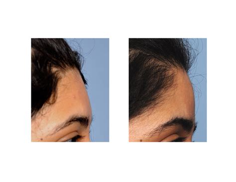 Blog Archivefemale Forehead Augmentation