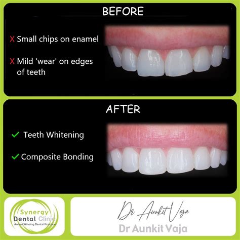 Composite Bonding Case 16 + Whitening • Synergy Dental Clinics