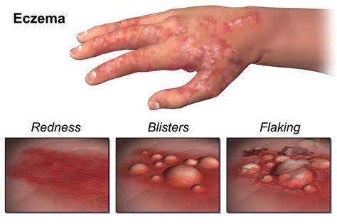 Difference Between Atopic Dermatitis And Eczema Atopic Dermatitis Vs