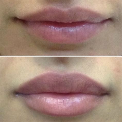 Juvederm Lips Revitta Cosmetic Clinic 2125351201 Manhattan Ny