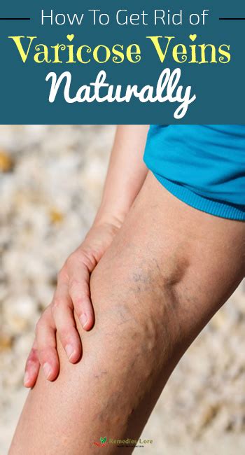 How To Get Rid Of Varicose Veins Naturally Remedies Lore