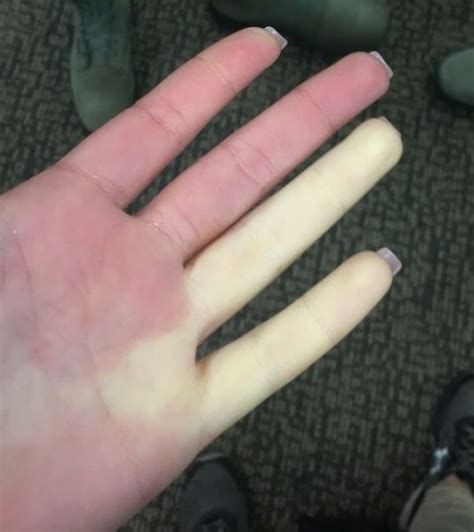 Raynauds Phenomenon Can Turn Fingers White Villages
