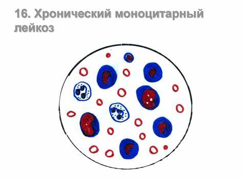 Лейкоз хронический диета