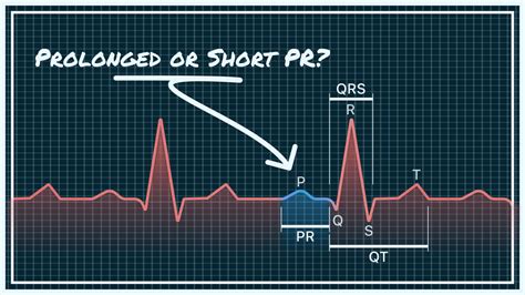 Qaly Pr Interval On Your Watch Ecg Short Normal And Prolonged