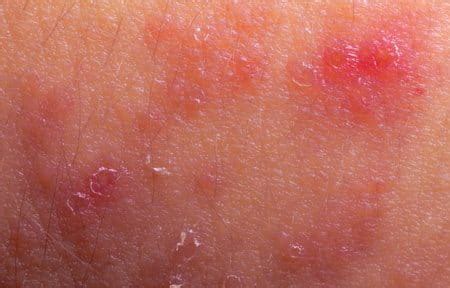 Dermatite At Pica Rosto Causas Sintomas Tratar Eucerin