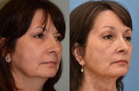 Before And After Head And Neck Reconstruction And Brow Lift Photos