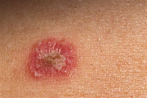 Cellulitis Stock Photos Pictures And Royalty Free Images Istock