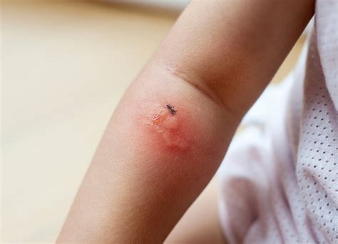 Check spelling or type a new query. Swollen mosquito bites - Phoenix Pest Control And ...