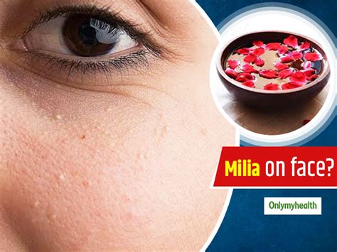 Having Milia On Your Face Here Are 10 Useful Home Remedies To Get Rid