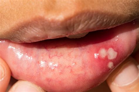 Mouth Ulcer Or Canker Sore Or Aphthous Stomatitis Or Aphthous Ulcer